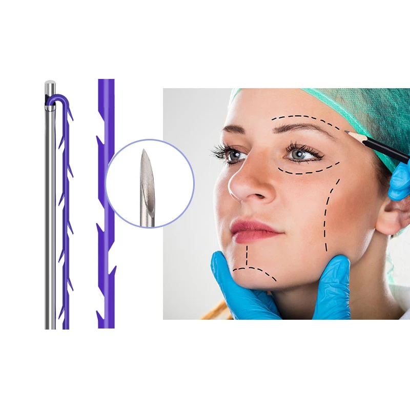 Fil de moulage