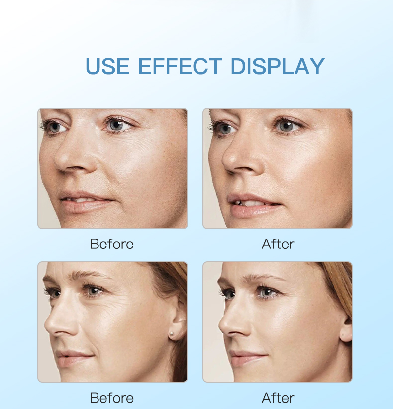 Skinbooster méso secret