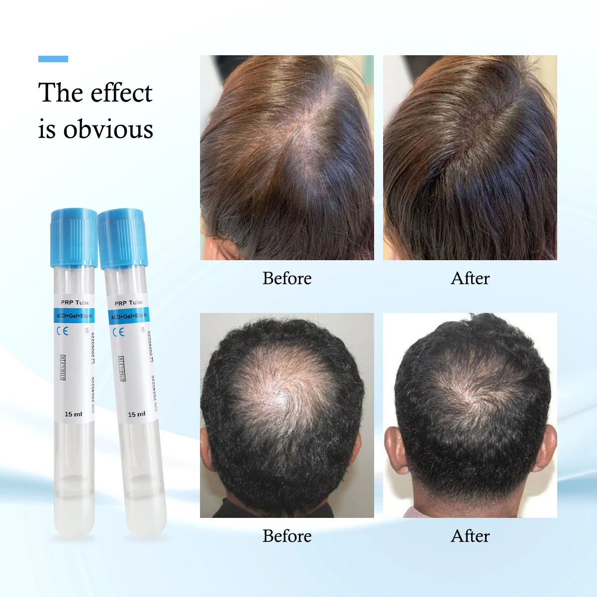 Tube PRP de biotine en gel ACD